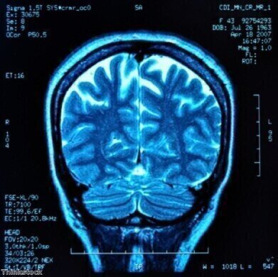 MRI can locate brain injuries in concussions