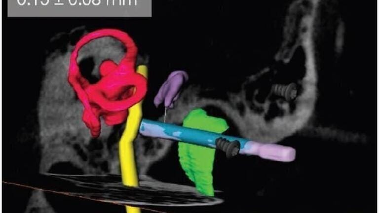 Thermal Cameras Help to Reduce the Invasiveness of Cochlear Implant Surgery