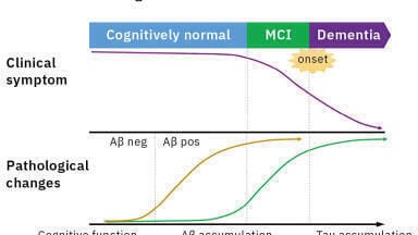 MS detection of Alzheimer’s blood-based biomarkers - From a few drops of blood - the first successful detection of plasma Aβ by MS