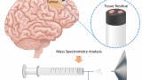 Rapid mass spectrometry could help identify glioma margins during brain surgery