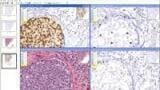 Fda Approval Received for Her2 Image Analysis Application
