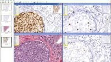 Fda Approval Received for Her2 Image Analysis Application