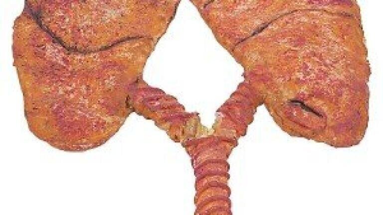 Never-smokers' lung tumours have 'greater genomic instability'