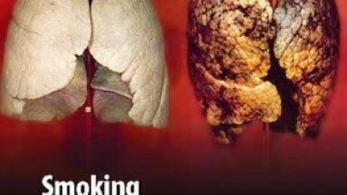 Scientists find link between thoracic surgical investment and UK lung cancer resection rate