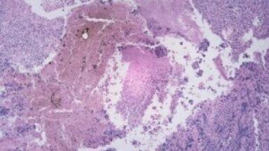 New technology makes cancer glow in the dark