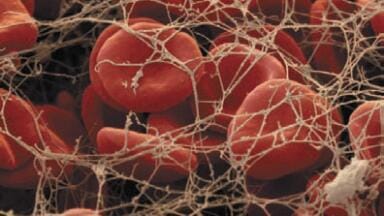 Test Kit Identifies Genetic Risk of  Thrombosis