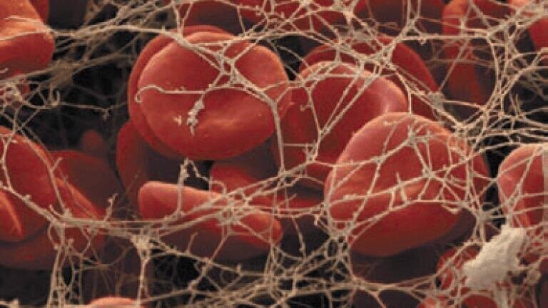 Test Kit Identifies Genetic Risk of  Thrombosis