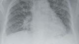 New Microarray-on-a-Chip Test for Cystic Fibrosis