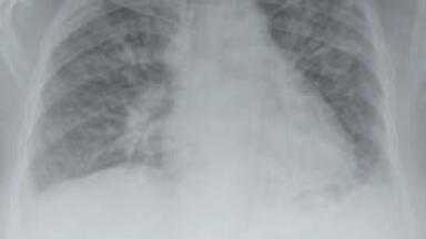 New Microarray-on-a-Chip Test for Cystic Fibrosis
