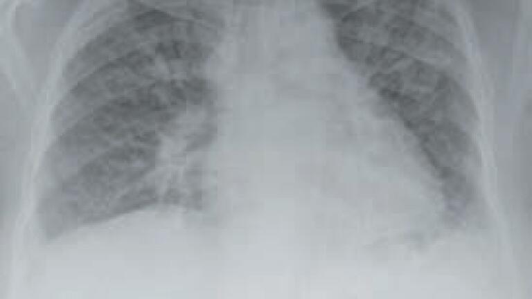 New Microarray-on-a-Chip Test for Cystic Fibrosis