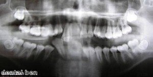 Scientists can use dental X-rays to predict fractures