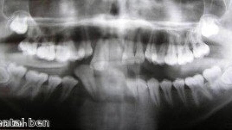 Scientists can use dental X-rays to predict fractures