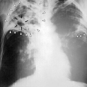 Scientists seek TB rapid test