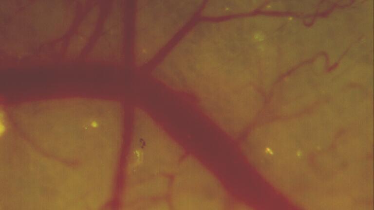 Magnification at 8.8x of a skin-flap.  Migrated dual-colored HT-1080 cells (bright yellow) within a distal vessel have begun to extravasate.  The field of view corresponds to a 1.7 x 1.7mm window.