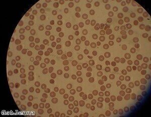 Diagnosis of malaria from drop of blood or saliva