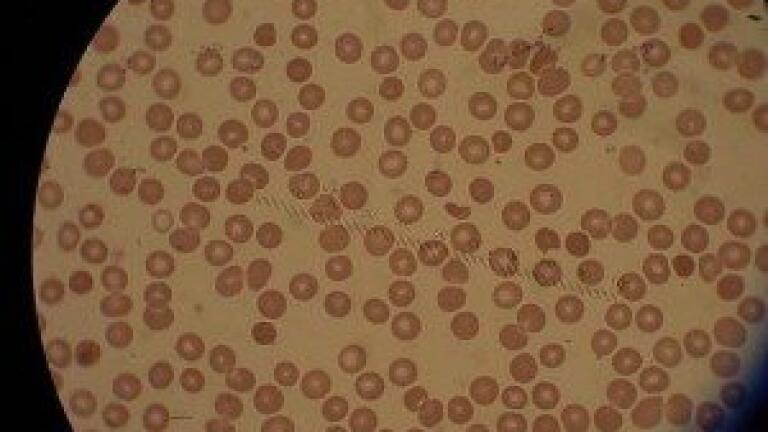 Diagnosis of malaria from drop of blood or saliva