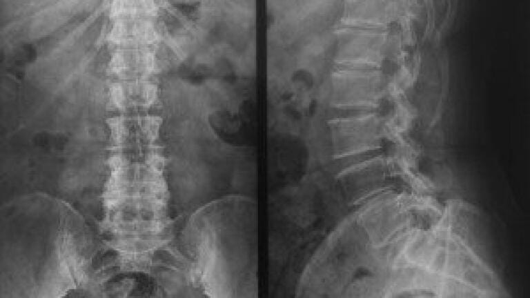 Repligen confirms licensing agreement with Pfizer for spinal muscular atrophy program