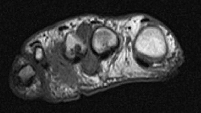 Researchers aim to improve outcomes of patients with RA in feet
