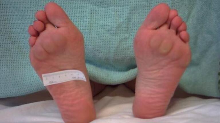 Inflamed bursae of the feet (Credit:University of Southampton)