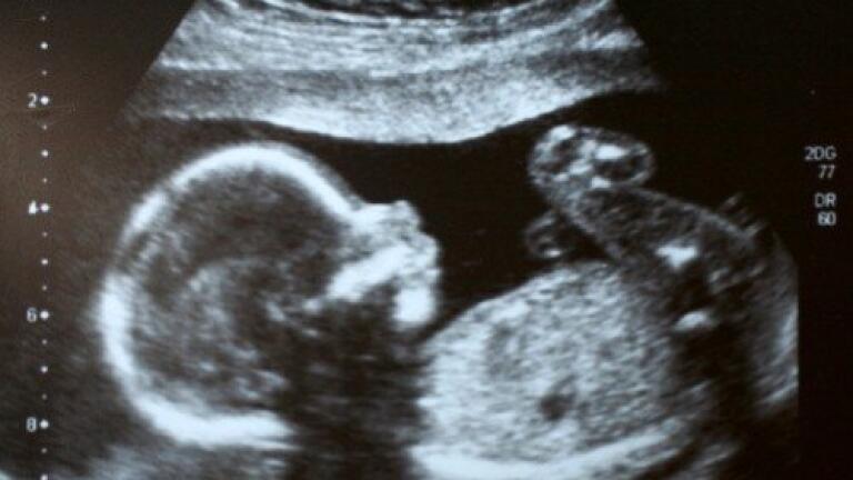 Viagra could lessen the risk of low birth weight