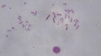 Scientists repress Down's syndrome extra chromosome