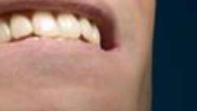 Stem cells used to grow human teeth