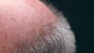Human hair successfully grown on mice