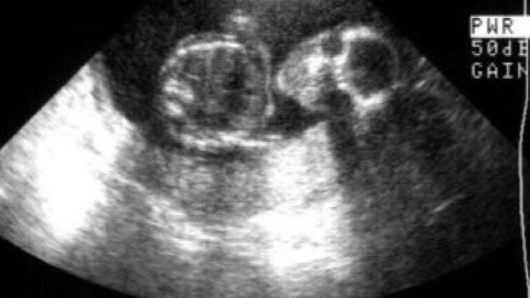 Breakthrough treatment allows infertile women to concieve
