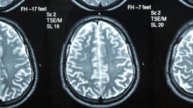 New drug proves effective at brain cancer treatment