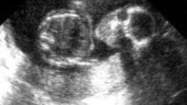 Early fetal growth 'impacts heart health'