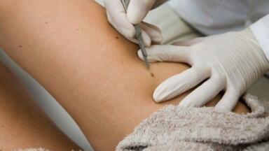 Skin cancer causing gene mutation identified