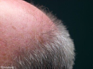 Researchers on the verge of cure for baldness