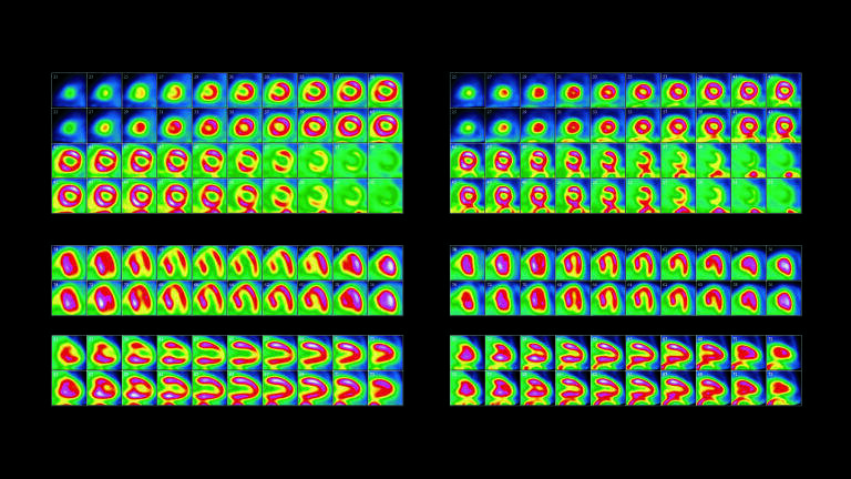 Myocardial Diffusion Imaging shows a patient’s heart before
and after surgery. To obtain the images, the patient was injected
with a chemical that binds to active myocardial (heart muscle)
tissue, and includes rubidium-82, a radioactive marker. This
emits gamma rays, so a gamma camera can make multiple
scans to create a 3D map of the active heart muscle. Here the
upper block shows slices from top to bottom of the heart, the
middle block shows slices from back to front and the lowest
block slices from the centre of the body outward. Alternate rows
show the heart stressed and resting. In the array of images at
left there are areas of significant missing activity, particularly
in the stress images. This is due to a 99% blockage of the left
anterior descending coronary artery. The blockage was treated
by implanting a stent (mesh-like tube) at the blockage site.Credit:Dr Eric Hong Cho Tek, EH Heart Specialist
Private Limited, Singapore