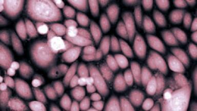Scientists Discover Link to Treatment for Prostate Cancer