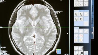 Man Uses Mind to Overcome Paralysis