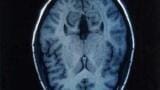 London-Japan Partnership to Target Neurodegenerative Diseases