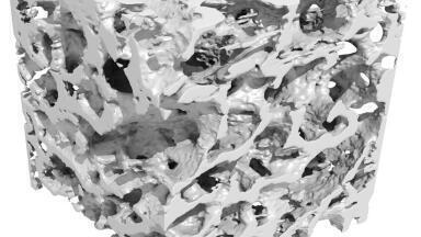 Laser X-Rays could spot tiny Fractures in Bone