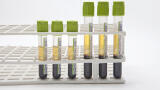 CE Mark for Next Generation Blood Separation Technology Received