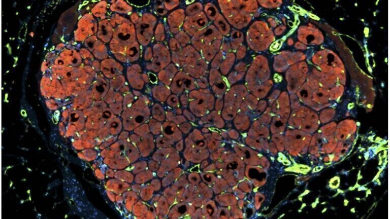 Engineering Human Liver Tissue Credit :Chelsea Fortin, Kelly Stevens and Sangeeta Bhatia, Koch Institute, © MIT. This small piece of human liver has been put into a mouse with a damaged liver. The human liver has started to grow using blood from the mouse to help. Researchers hope that one day this could be used to help people with damaged livers. This picture is 1.1 mm wide.
This image appeared as a result of the partnership between Wellcome Images and the Koch Institute at MIT.
