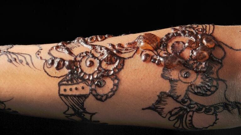 Black Henna Allergy Credit: Nicola Kelley, Cardiff and Vale University Hospital NHS Trust. A black henna tattoo on the arm of a young girl. Henna is a dye that people use to draw on their skin, but it disappears over time. This girl has blisters on her arm because she is allergic to the dye. The blisters will heal but they may leave marks on her skin.