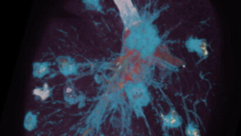 Probe speeds detection of deep lung infections in Patients