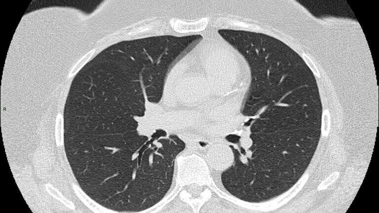 CT scan of chest