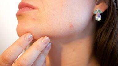 What Causes Teenage Acne?