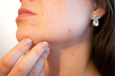 What Causes Teenage Acne?