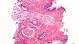Biomarker Complements Prostate Cancer Checks