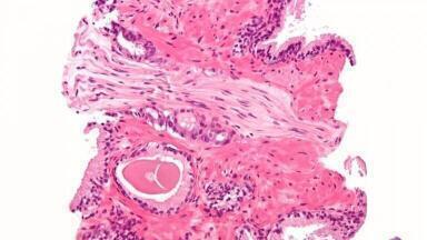 Biomarker Complements Prostate Cancer Checks
