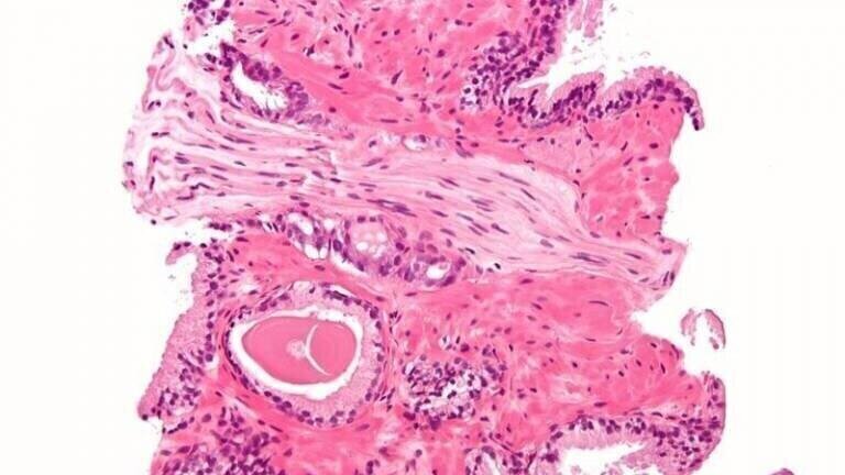 Biomarker Complements Prostate Cancer Checks