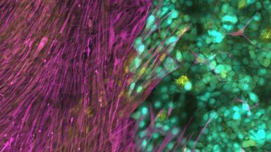Cancer Cells Build Protection Against Viral Therapies