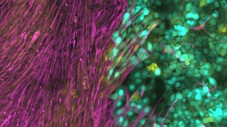Cancer Cells Build Protection Against Viral Therapies
