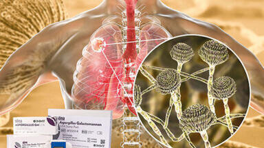 Invasive Aspergillosis Screening in COVID-19 and Critical Care Patients
